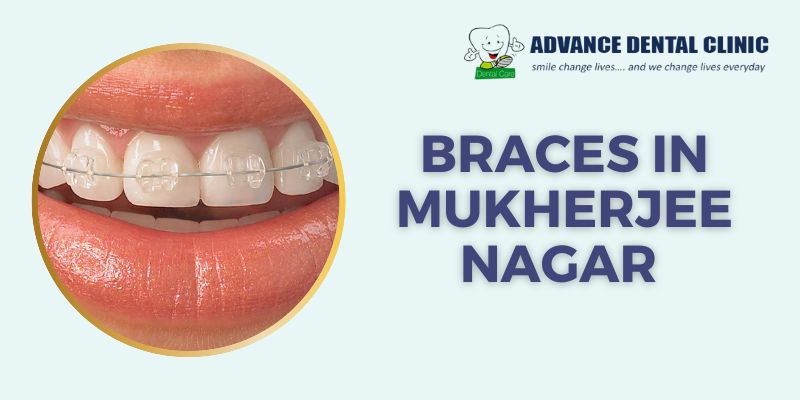 Braces In Mukherjee Nagar | Advancedentalclinic
